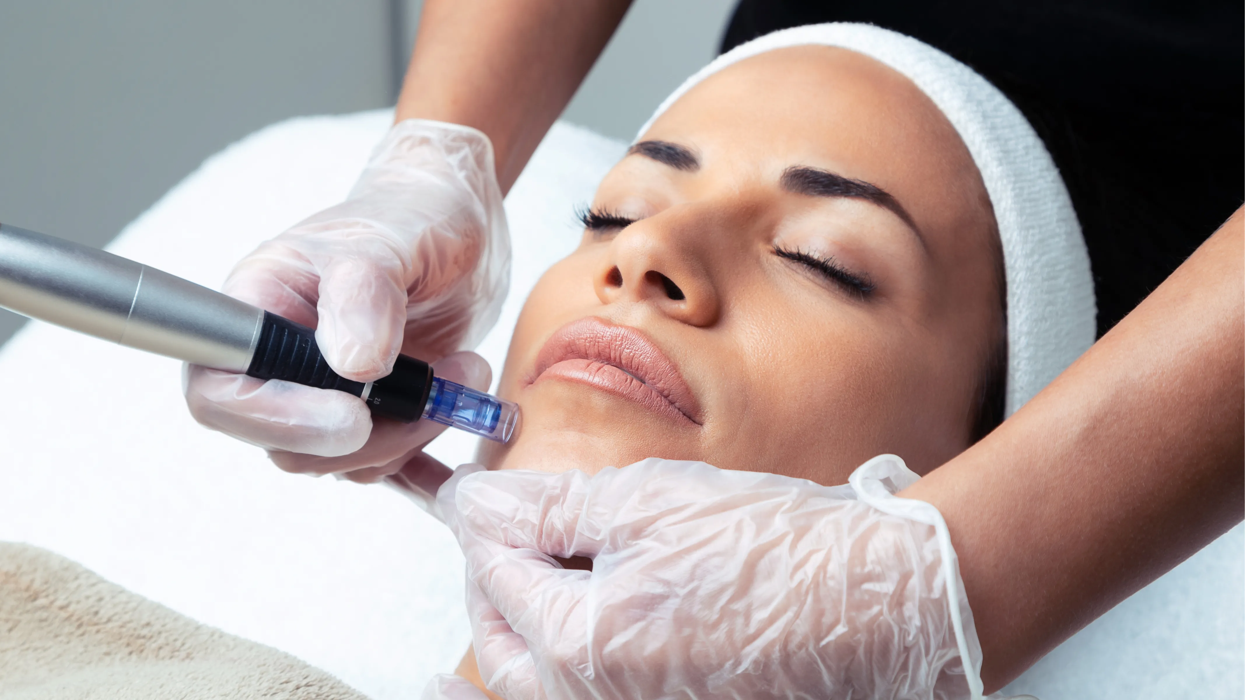 - Microneedling -