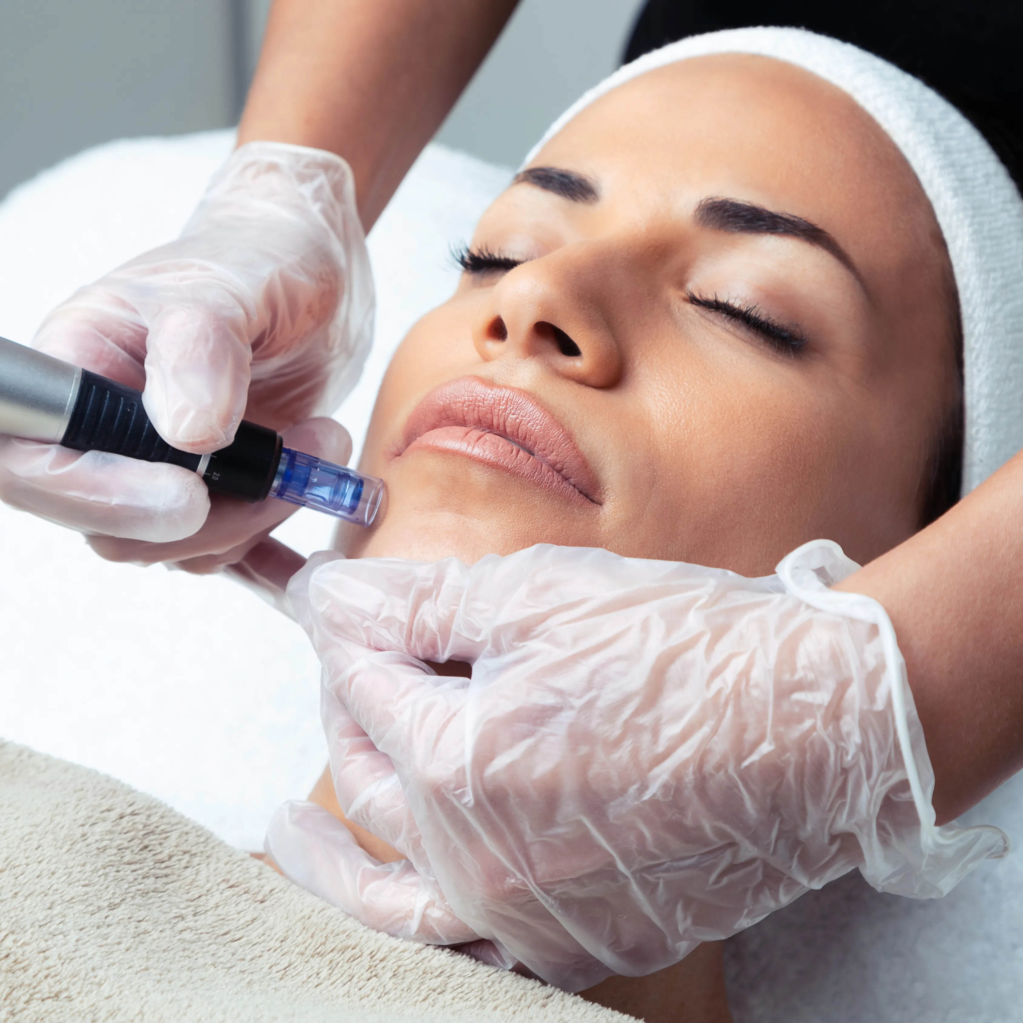 Microneedling