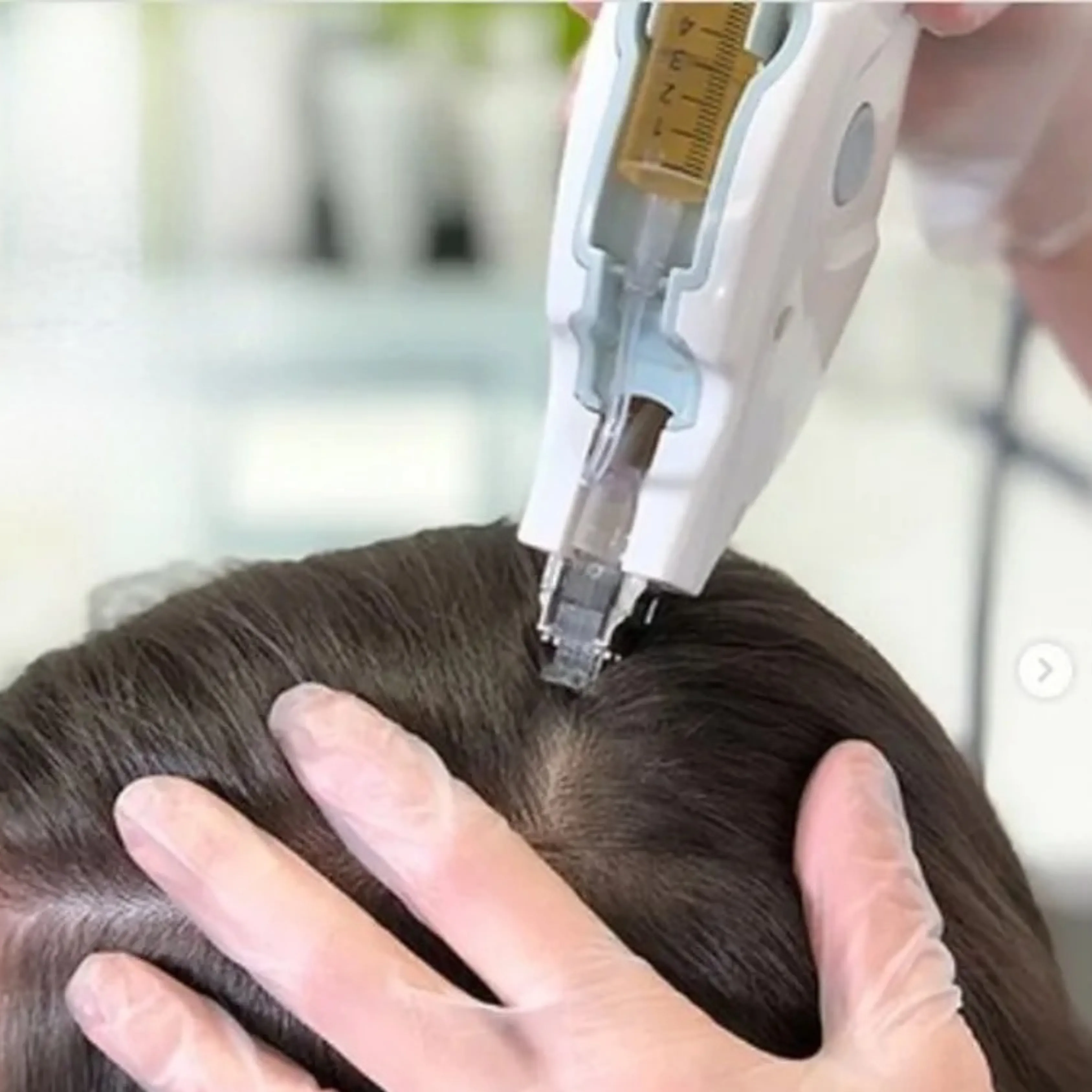 Mesotherapie haare - Mesohair